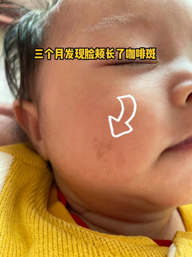 30%的孩子有咖啡牛奶斑,小孩牛奶咖啡斑越长越多的原因