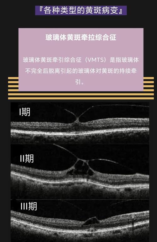 ped在眼科的意思,眼睛ped是啥病严重吗