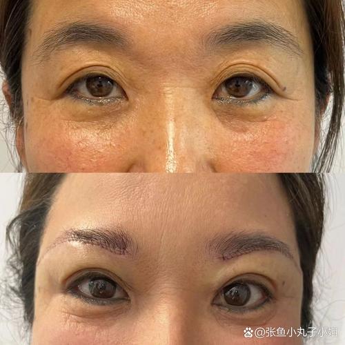 什么是提眉术前后对比照片,提眉术前后对比照片有伤害吗