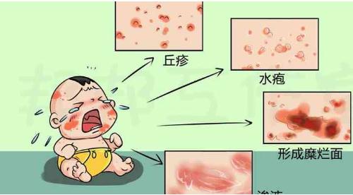 去除婴儿热疹小妙招-湿疹为什么要大量擦润肤乳