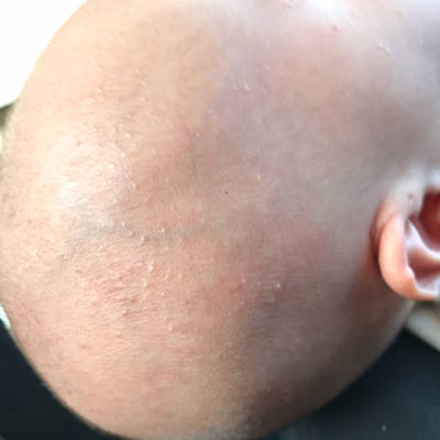 去除婴儿热疹小妙招-小孩热疹最佳治疗方法
