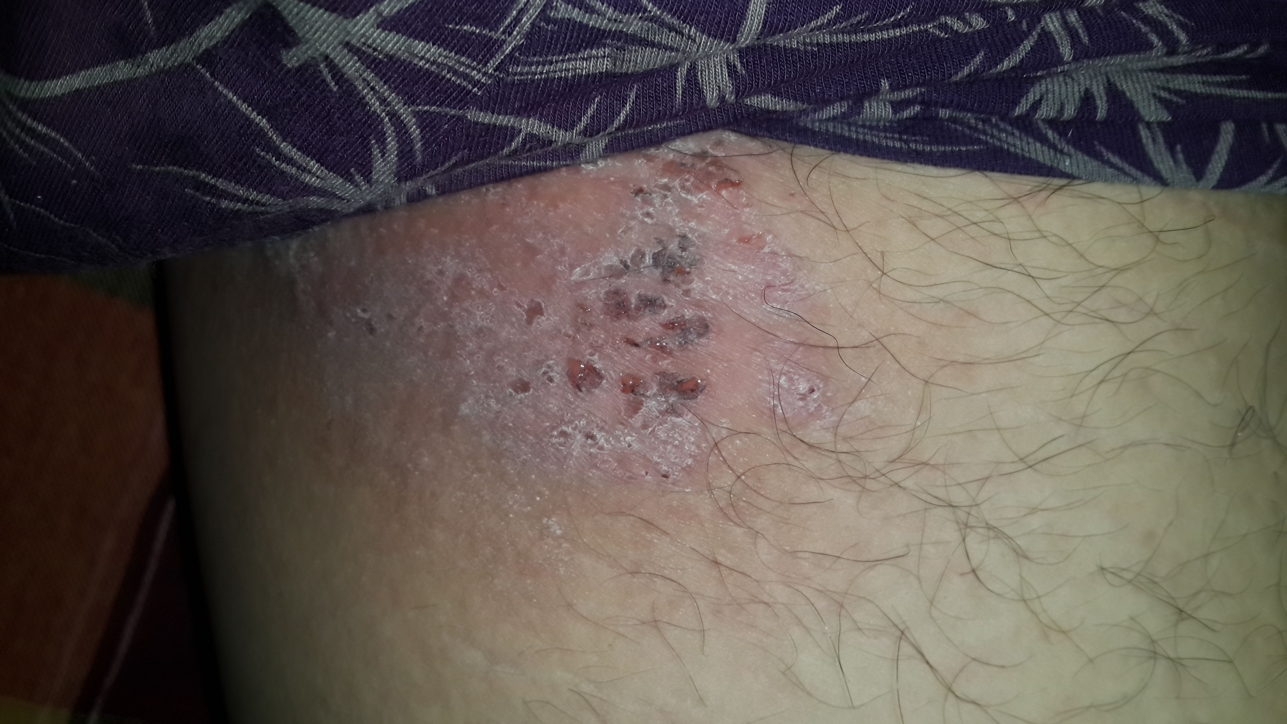 大腿根部很痒还有包-大腿根部很痒一抓就有好多包