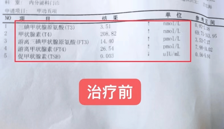 TSH和TG升高的简单介绍